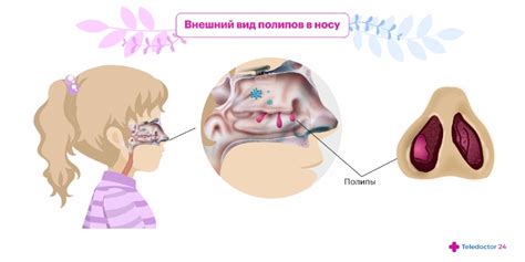 Предотвращение образования казеозных пробок в носу у ребенка