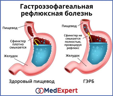 Предотвращение рефлюкса