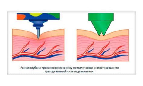 Преимущества использования аппликатора Ляпко при грыже позвоночника