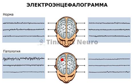 Преимущества и ограничения проведения ЭЭГ во время сна