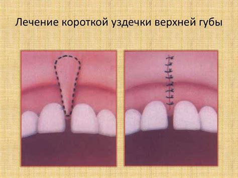 Преимущества и риски подрезания уздечки губы у взрослых