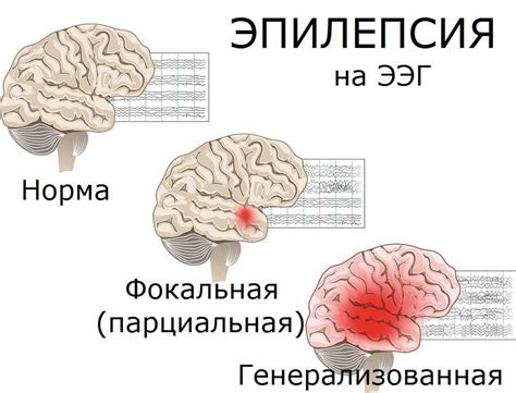 Признаки эпилепсии у Петра 1