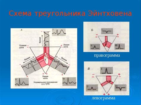 Применение треугольника Эйнтховена в медицинской диагностике