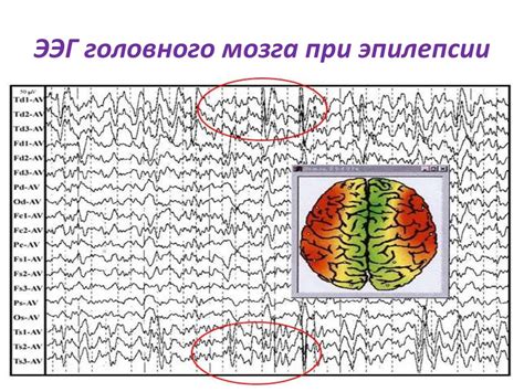 Принципы электрофореза при эпилепсии