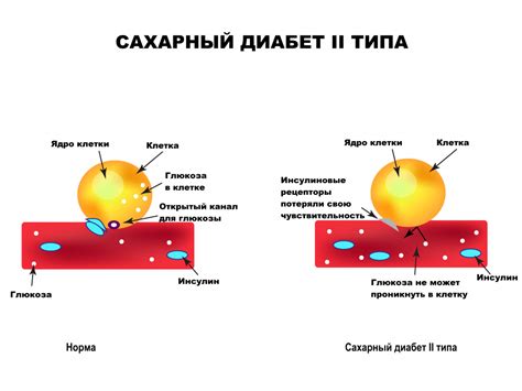 Причины возникновения жажды при сахарном диабете 2 типа