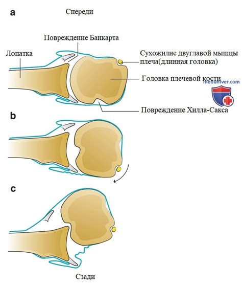 Причины вывиха плеча у детей и способы его предотвращения