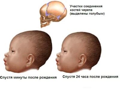 Причины выравнивания формы головы у грудничка