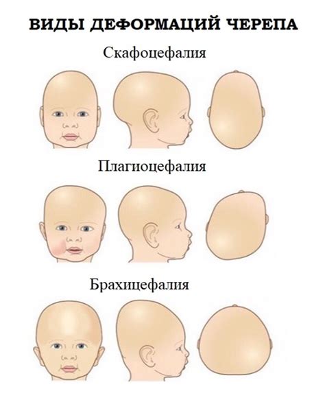 Причины деформации формы головы