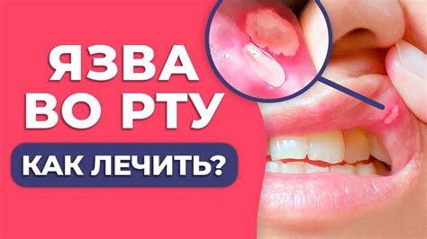 Причины остроты во рту