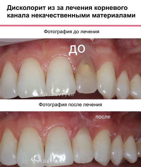 Причины появления черноты на колечке