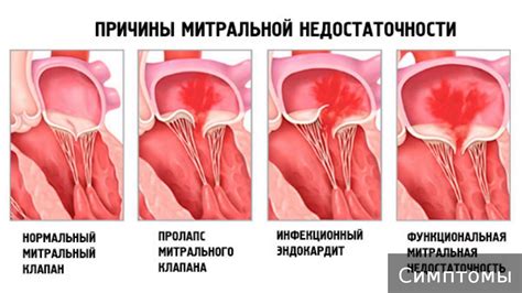 Пролапс митрального клапана: можно ли избавиться?