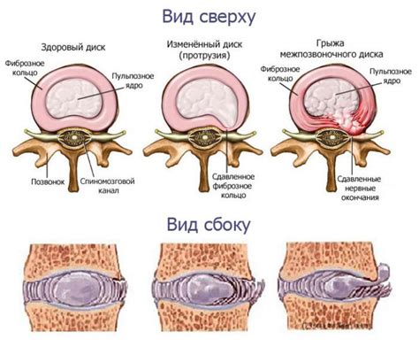 Протрузия позвоночника и ее проявления