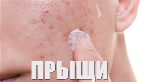 Профессиональные методы борьбы с закрытыми комедонами на лбу