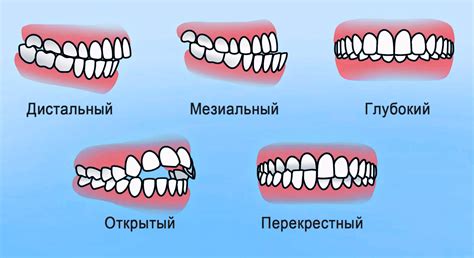 Профилактика неправильного прикуса