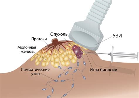 Процедура удаления лимфоузла под молочной железой