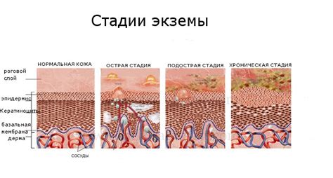 Проявление экземы у поваров: основные симптомы