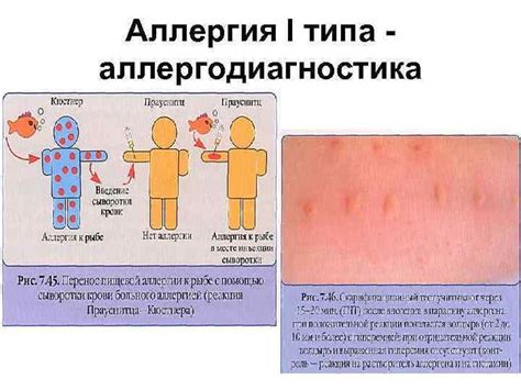 Развитие аллергических реакций при проведении диаскинтеста у взрослых