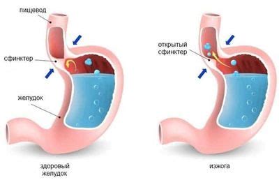 Различные мятные напитки и их влияние на изжогу