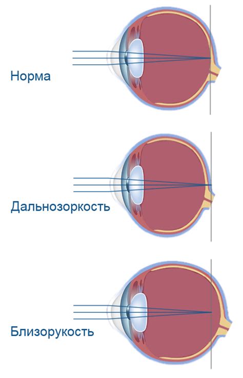 Различные причины плохого зрения