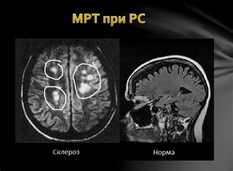 Рассеянный склероз: Возможно ли его полное излечение?