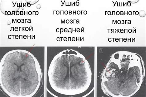 Рвота как симптом сотрясения мозга