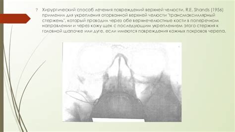 Регулярность и правильность выполнения упражнений для укрепления верхней челюсти