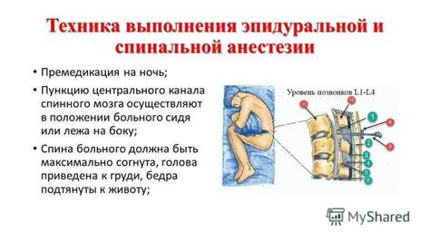 Рекомендации по движению при эпидуральной анестезии