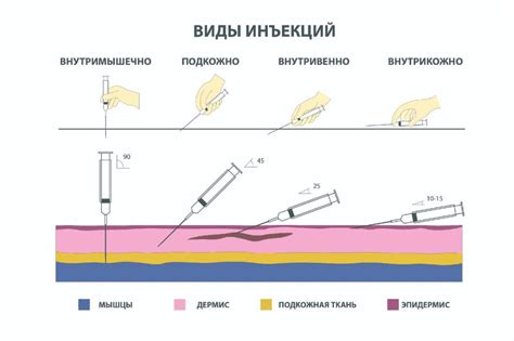 Рекомендации по инъекции в ногу