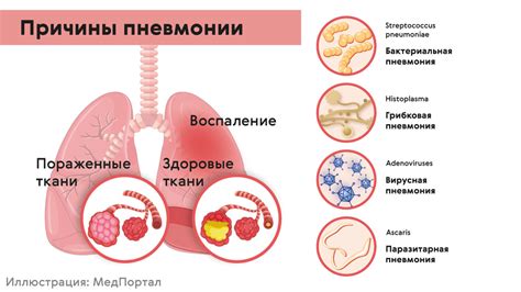 Рекомендации по снижению температуры при пневмонии