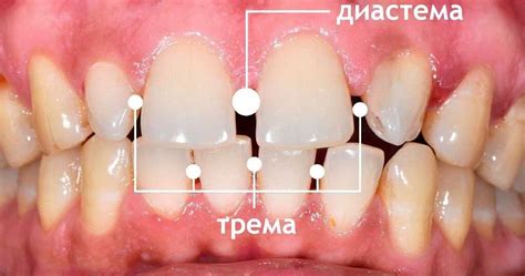 Связь между курением и состоянием зубов