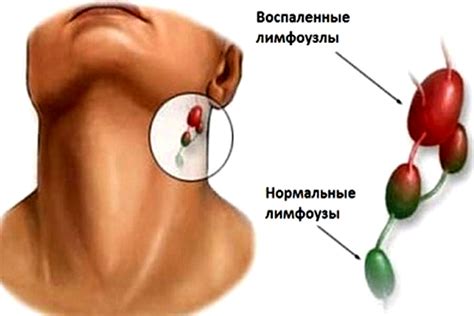 Симптомы воспаления лимфоузлов