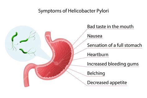 Симптомы инфекции Helicobacter pylori