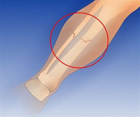 Симптомы и диагностика трещины в ноге
