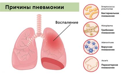 Симптомы и причины пневмонии