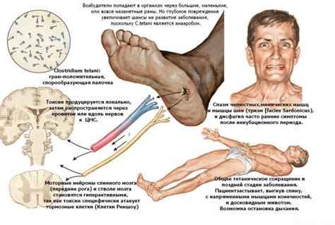 Симптомы и проявления столбняка у человека