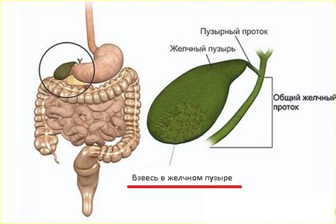 Симптомы наличия сладжа в желчном пузыре