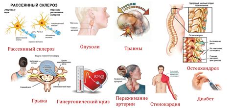 Симптомы обострения рассеянного склероза