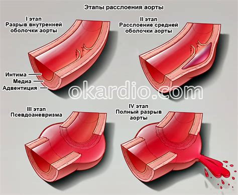 Симптомы разрыва аорты