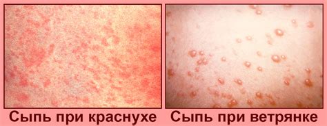 Симптомы сыпи при повышении температуры