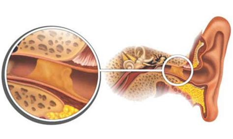 Симптомы ушных пробок
