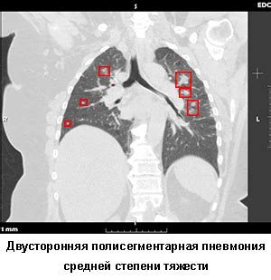 Сколько стоит КТ-сканирование легких: сравнение цен