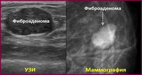 Снижение болей при фиброаденоме