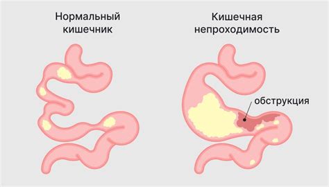 Снижение воспаления кишечника