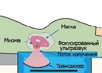 Современные методы диагностики миомы