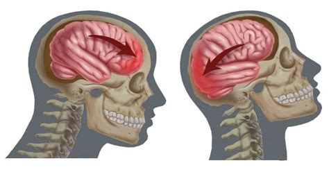 Сотрясение мозга - что это такое?