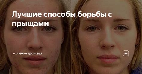 Способы борьбы с прыщами без давления