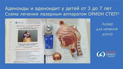 Способы быстрого снятия отёка аденоидов в домашних условиях: безопасность и эффективность