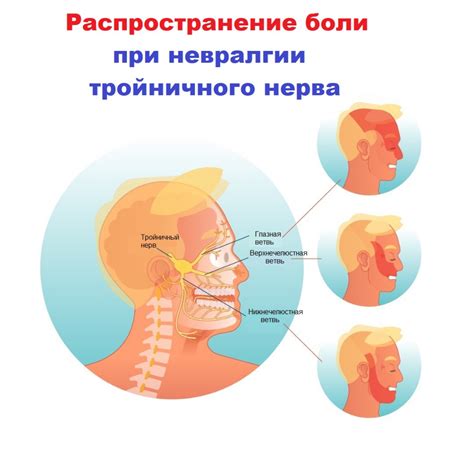 Способы лечения и профилактики тошноты при заболеваниях тройничного нерва