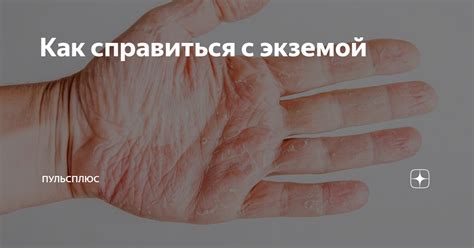 Способы справиться с экземой для поваров