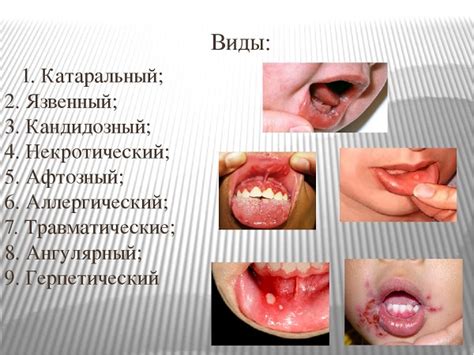 Стоматит у детей: важные аспекты проблемы